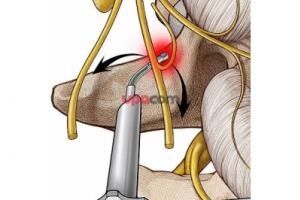 Система PERCULINE joint для фасеточных суставов